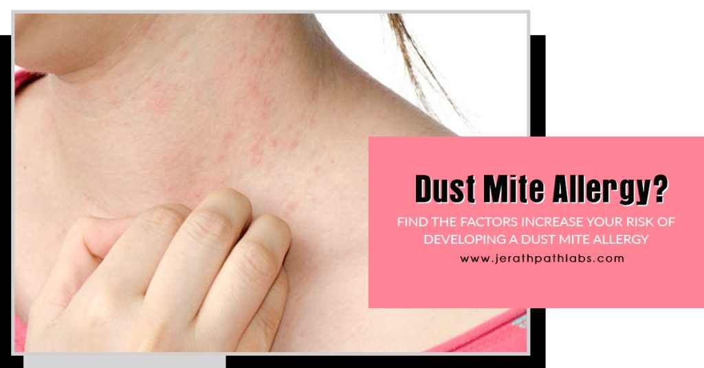 Dust Mite Allergy